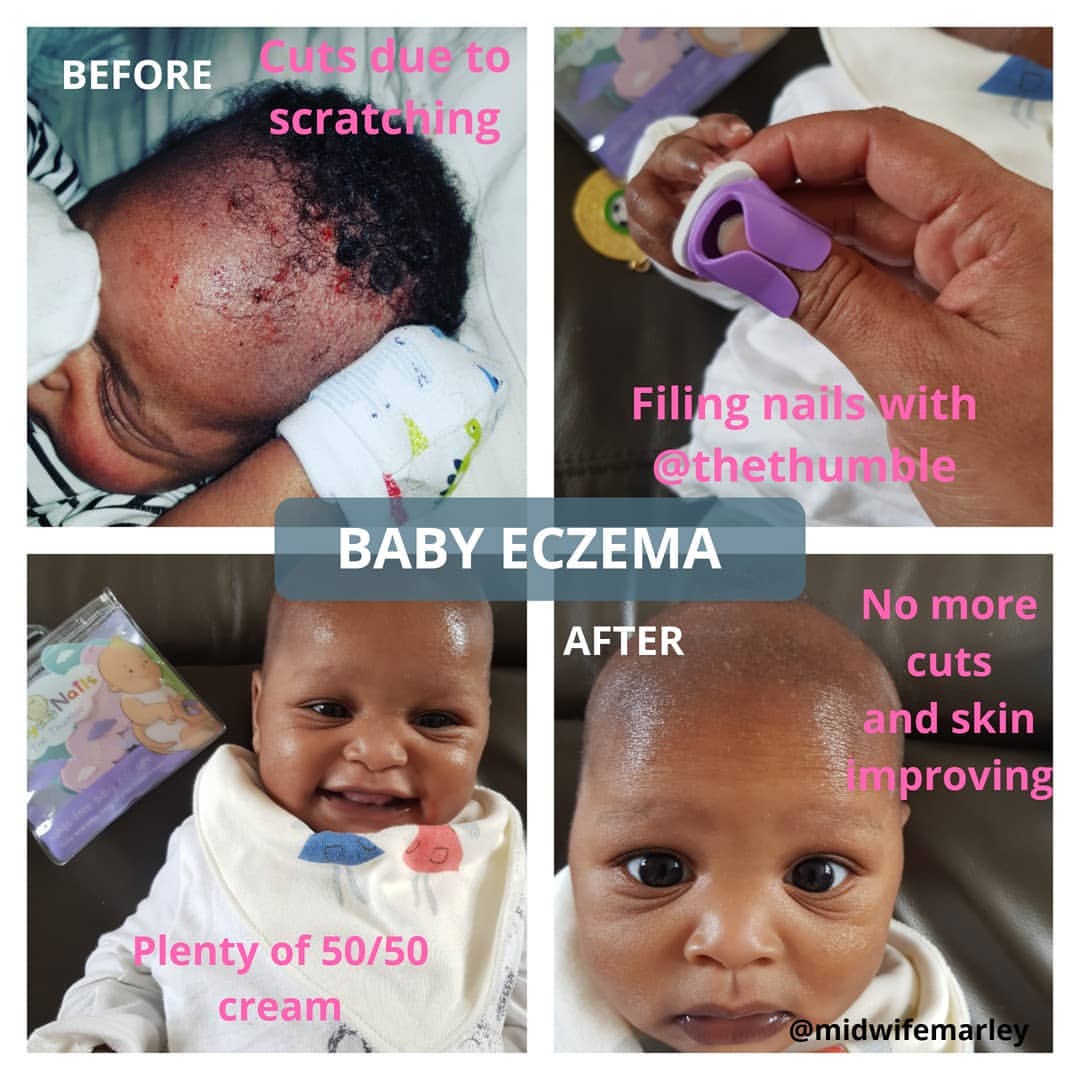 Filing your baby's nails keeps them short to prevent scratching in baby eczema